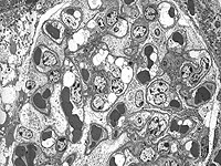 Wilms tumour research