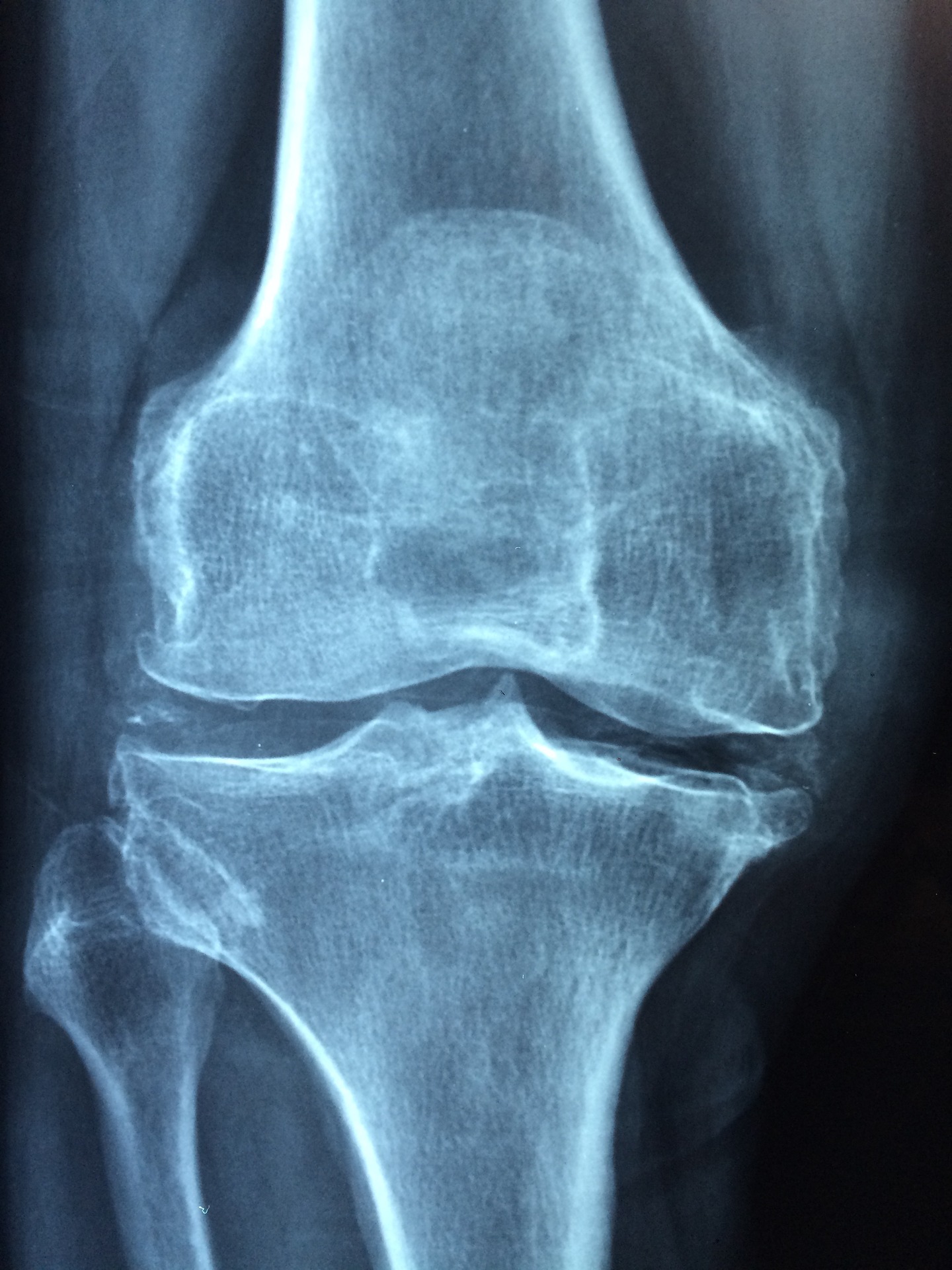 Xray image of a knee