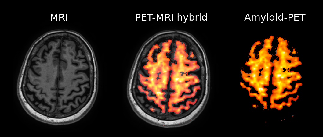 healthy volunteer amyloid-PET scan, combined with MRI.