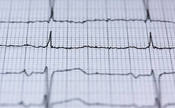 Electrocardiogram