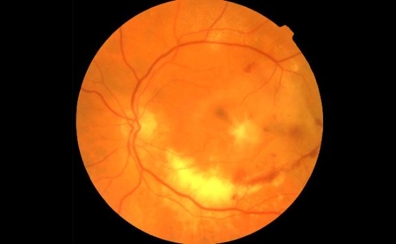 Intelligent Health: diabetic retinopathy