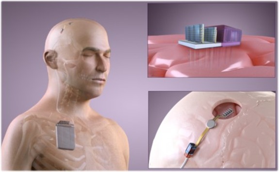 Diagram of brain prostheses to prevent seizure in epilepsy patients